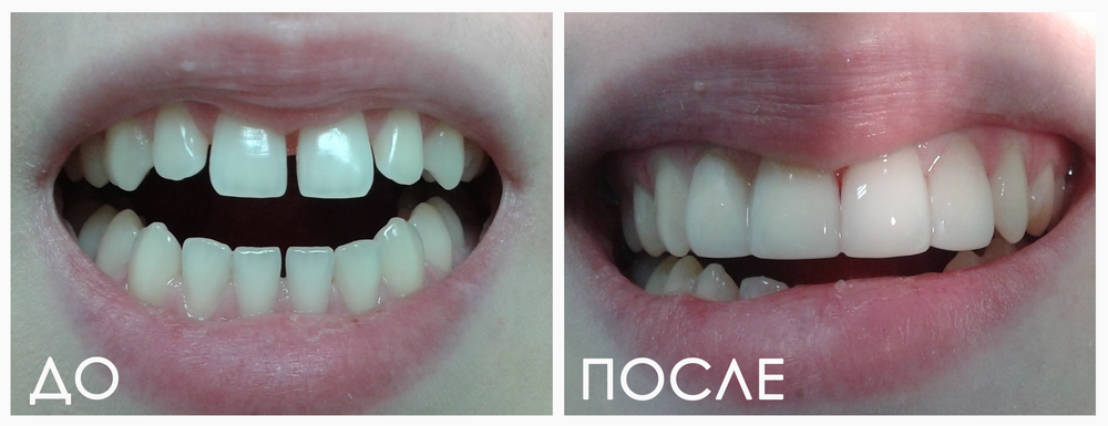 Виниры любой сложности — пример работ стоматологии Респект Тольятти