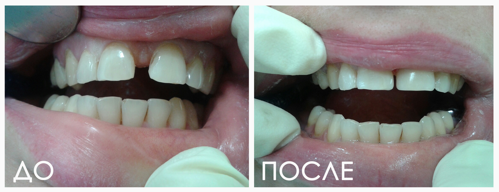 Нанокомпозитные виниры