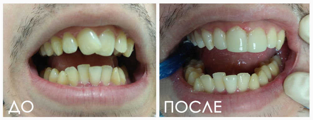 Виниры любой сложности — пример работ стоматологии Респект Тольятти