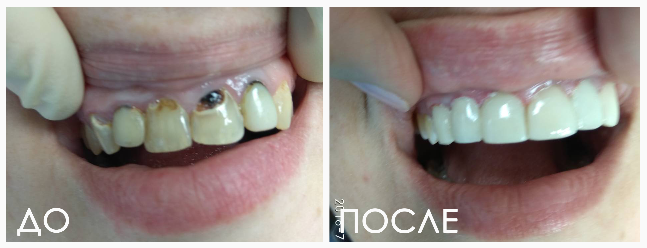 Виниры любой сложности — пример работ стоматологии Респект Тольятти