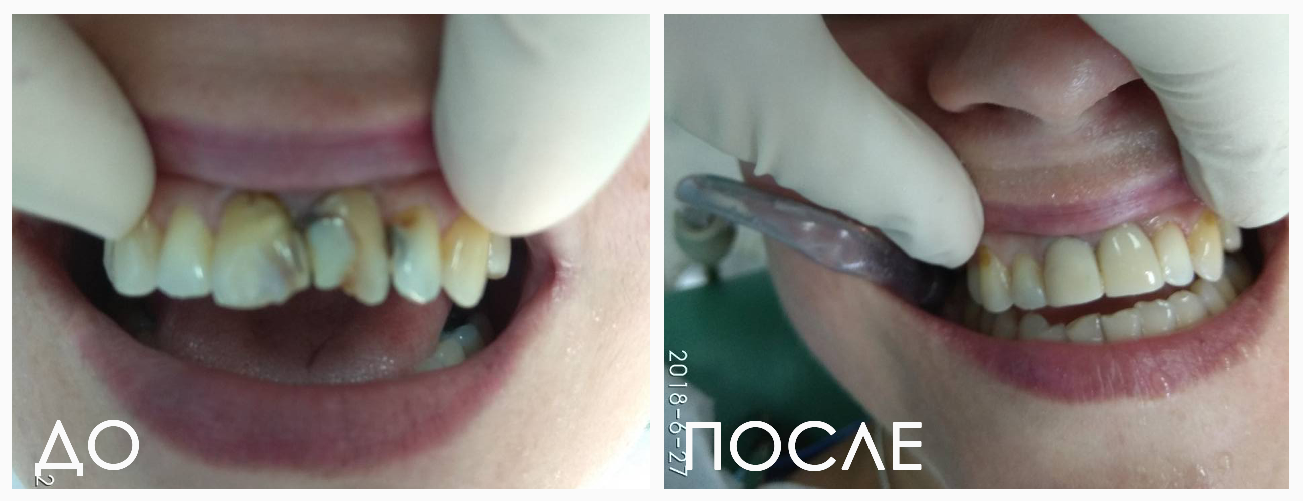 Виниры любой сложности — пример работ стоматологии Респект Тольятти